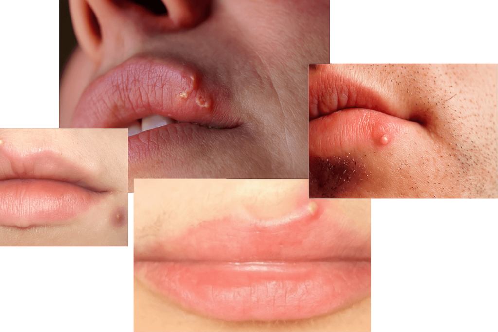 How to Get Rid of Whitehead Pimples on Lips: Complete Solution